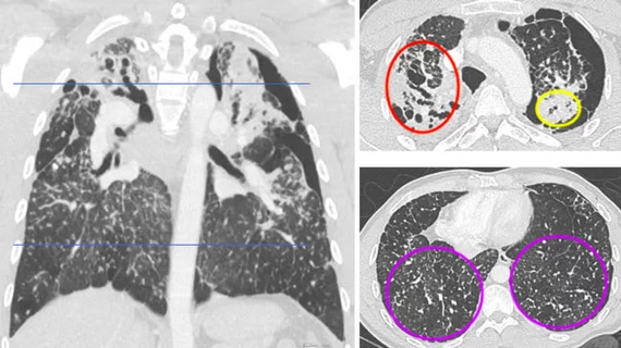 Silicosis on CT