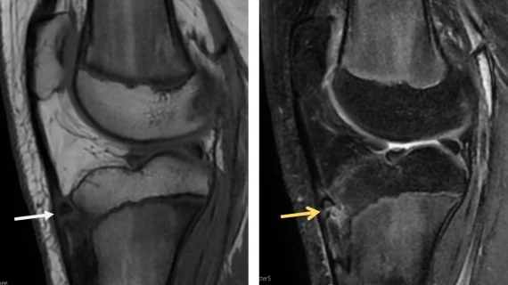 MRI of knee with Osgood-Schlatter Disease