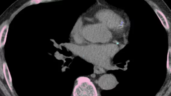 AI completes CAC assessment using routine LDCT scan