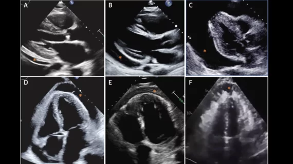 Pericardial Effusion Sizing Evaluation by Echocardiography. Representative (A) small, (B) moderate, and (C) large PEffs (∗). Representative (D) simple PEff with fibrin strands, (E) exudative PEff, and (F) malignant PEff (∗) caused by pericardial mesothelioma. Adapted with permission from Klein et al. Images and caption courtesy of the American College of Cardiology and JACC.pericarditis cardiac imaging