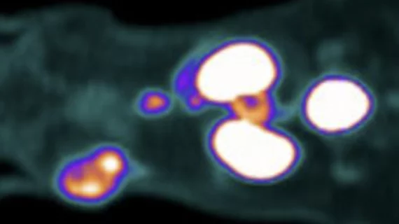 Dual-mode radiotracer helps surgeons 'hear' invisible cancer lesions