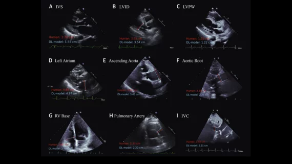 Cardiologists have developed an open-source artificial intelligence (AI) model capable of accurately evaluating a long list of measurements on echocardiography results. The group detailed the development and validation of that model in the Journal of the American College of Cardiology. A comparison of measurements made by a sonographer (in red) and predictions from the deep learning model (in light blue) across 9 echocardiographic parameters. Image and caption courtesy of Ouyang et al., JACC.