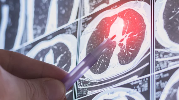 lung cancer screening low-dose CT