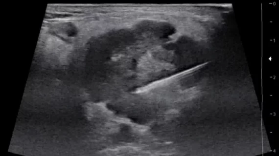 New ultrasound needle yielded more substantial tissue samples