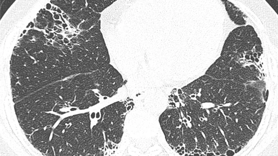 A study published this week in Radiology found that 12 months after hospitalization for COVID pneumonia, 93% of patients’ lung abnormalities had cleared up on follow-up chest CT scans.#covidpneumonia #groundglassopacities